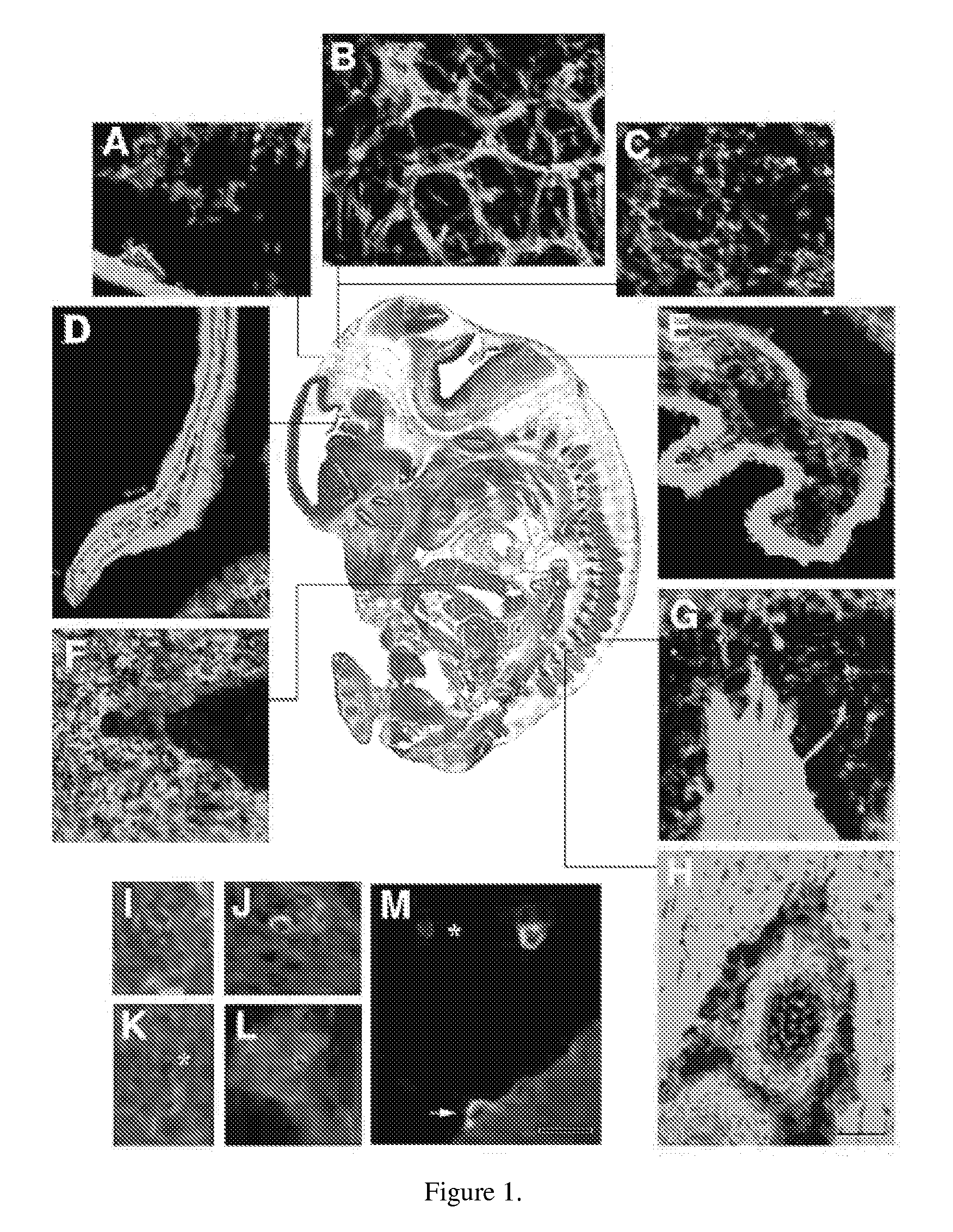 Method of prenatal administration of mammalian umbilical cord stem cells for the intrauterine treatment of sanfilippo syndrome