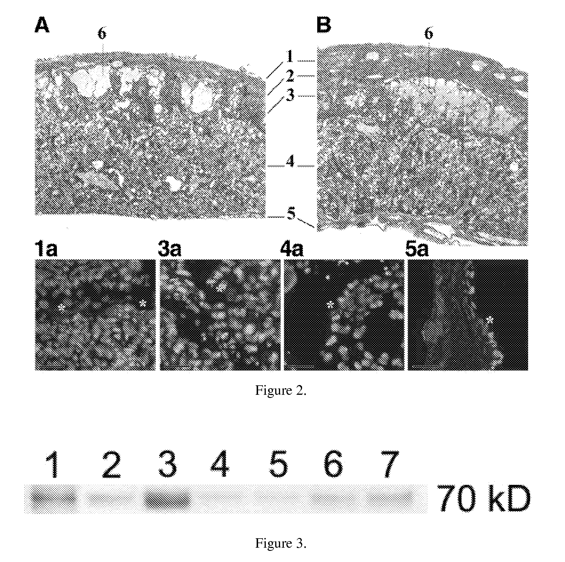 Method of prenatal administration of mammalian umbilical cord stem cells for the intrauterine treatment of sanfilippo syndrome