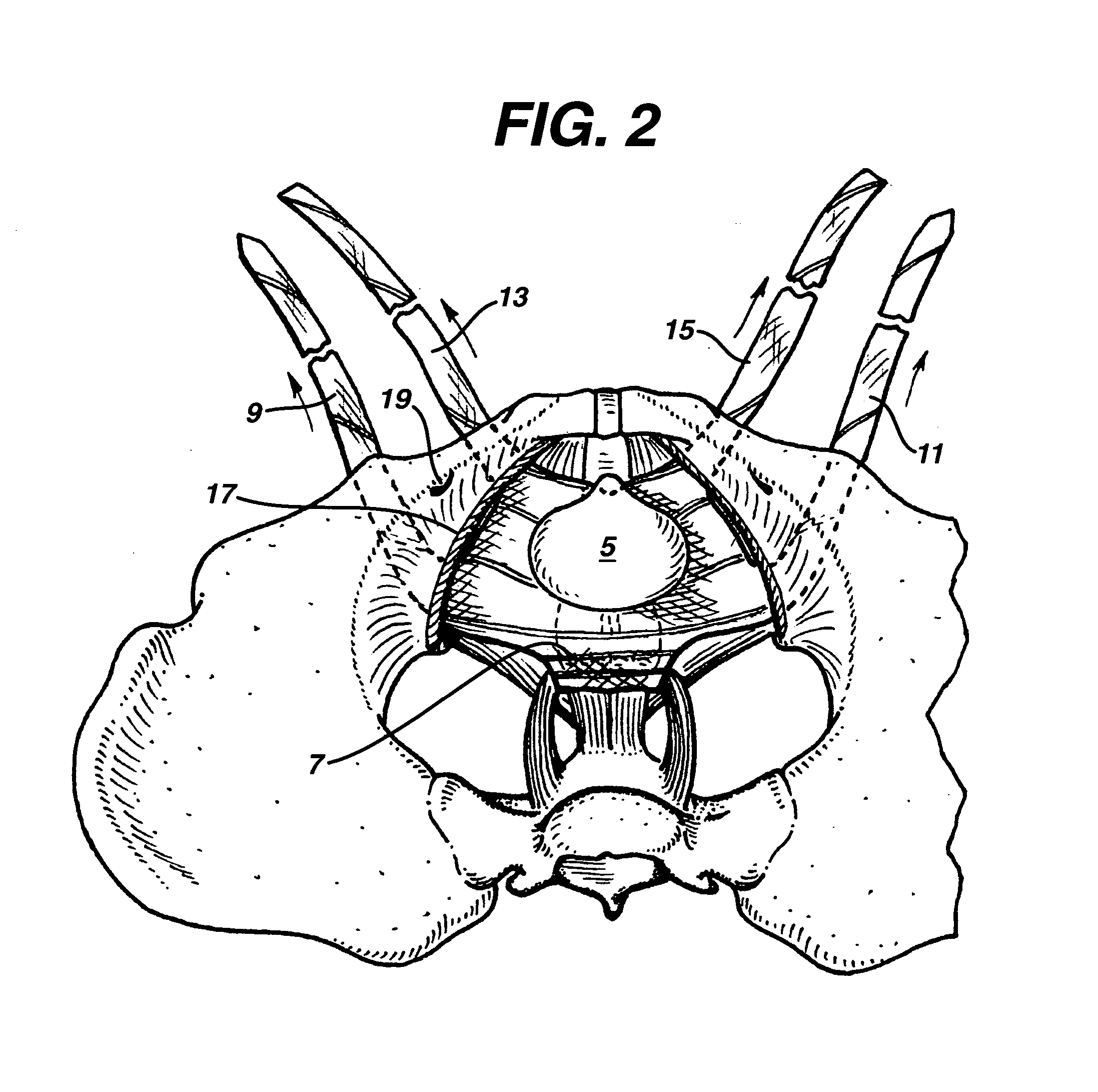 System and method for surgical implant placement