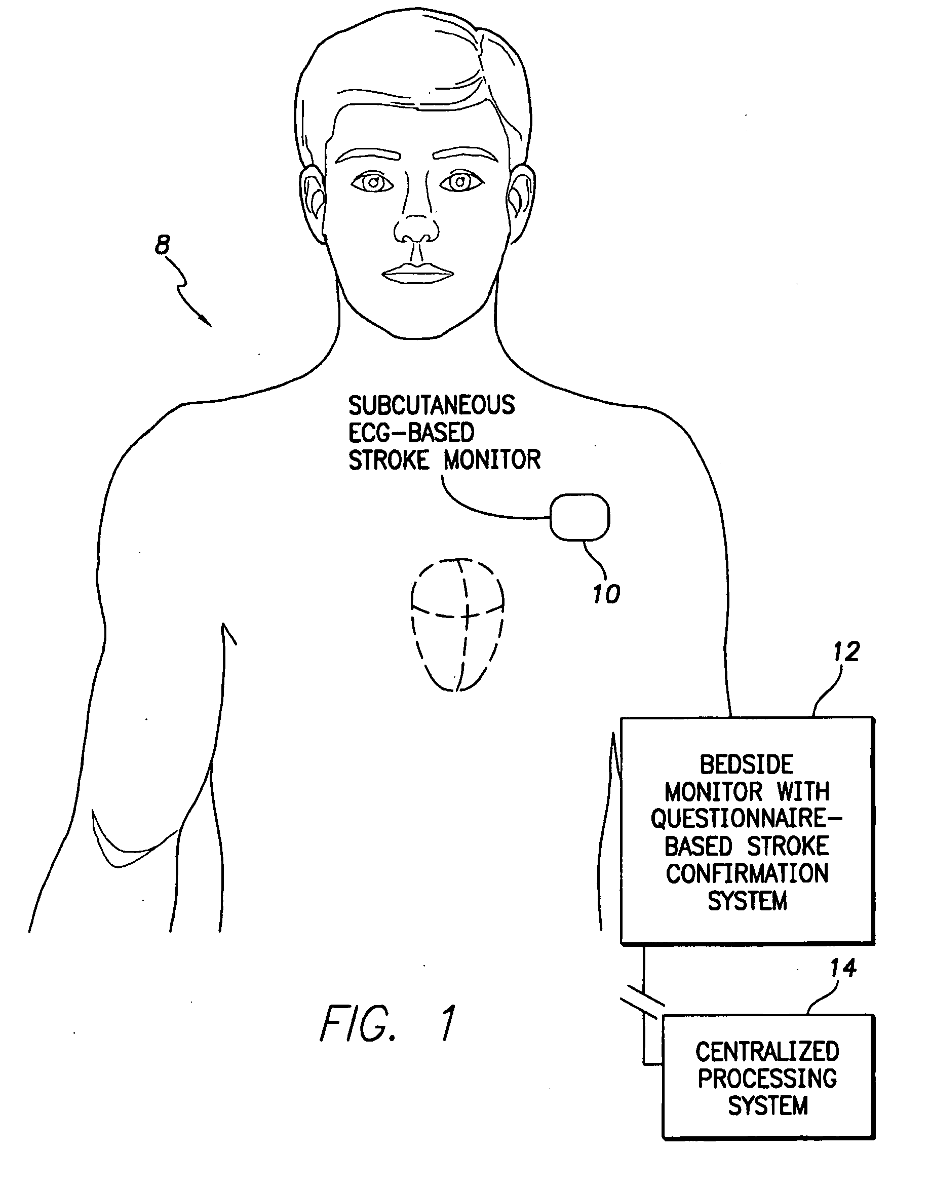 Systems and Methods for Use with an Implantable Medical Device for Detecting Stroke Based on Electrocardiac Signals