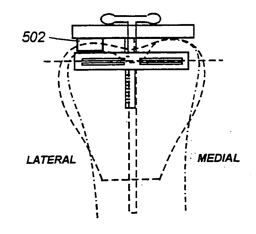 Optimizing patellar femoral mechanics through alternative depth referencing