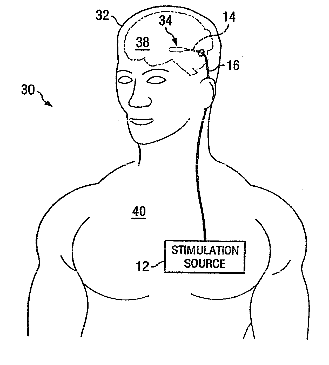 Electrical stimulation system and method for stimulating tissue in the brain to treat a neurological condition