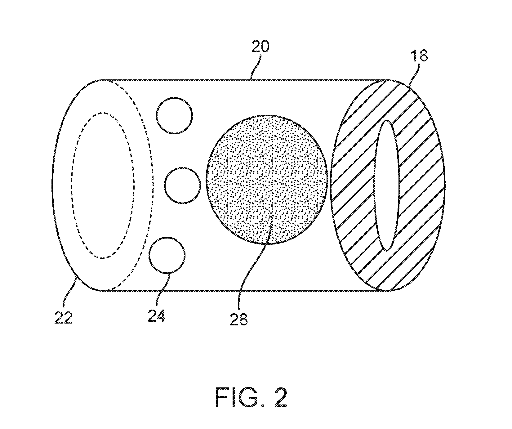 Venous valve prosthesis