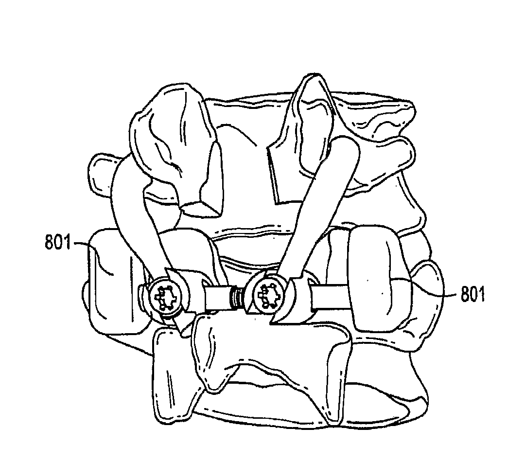 Crossbar spinal prosthesis having a modular design and systems for treating spinal pathologies