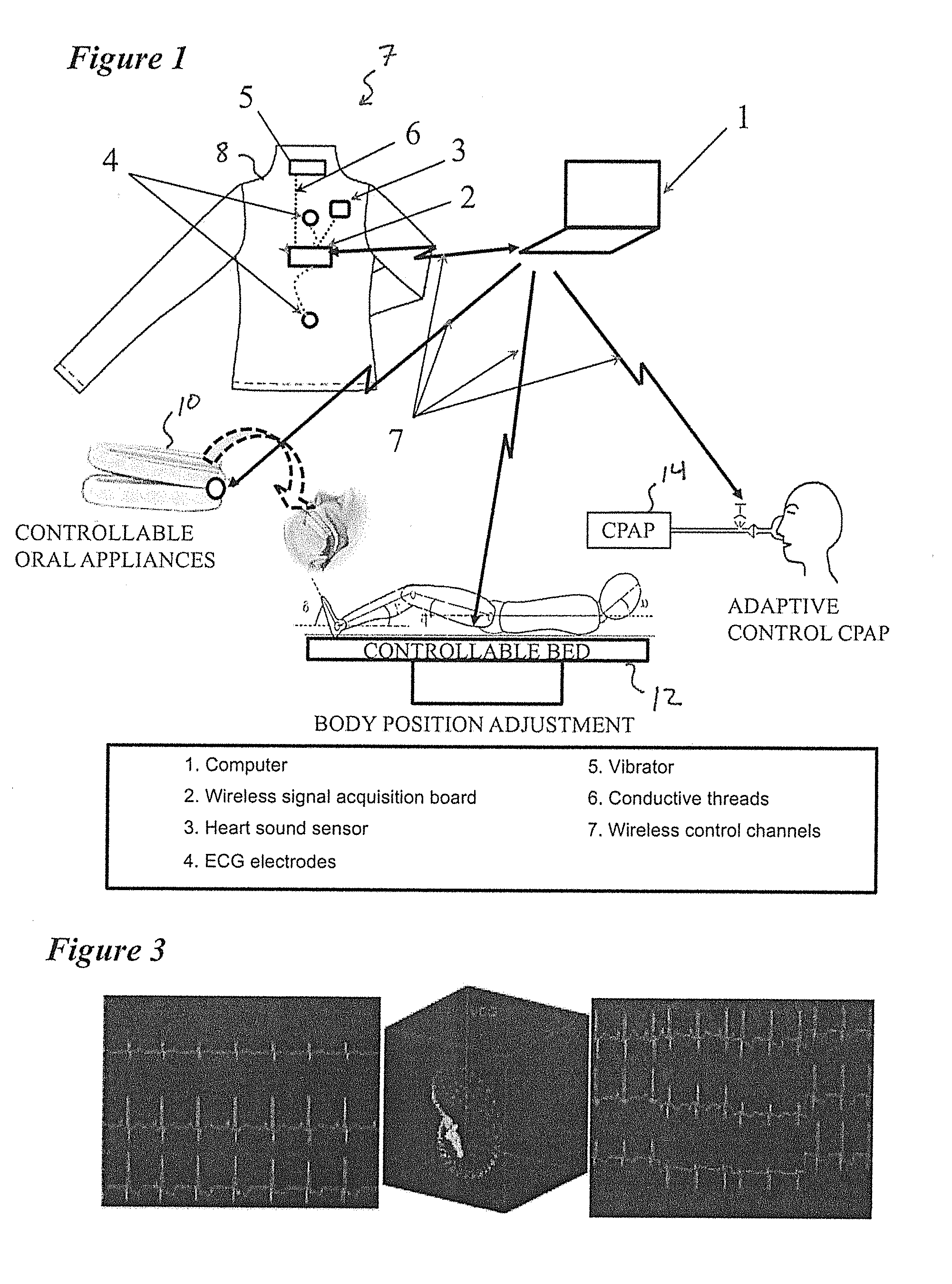 Device and method for predicting and preventing obstructive sleep apnea (OSA) episodes