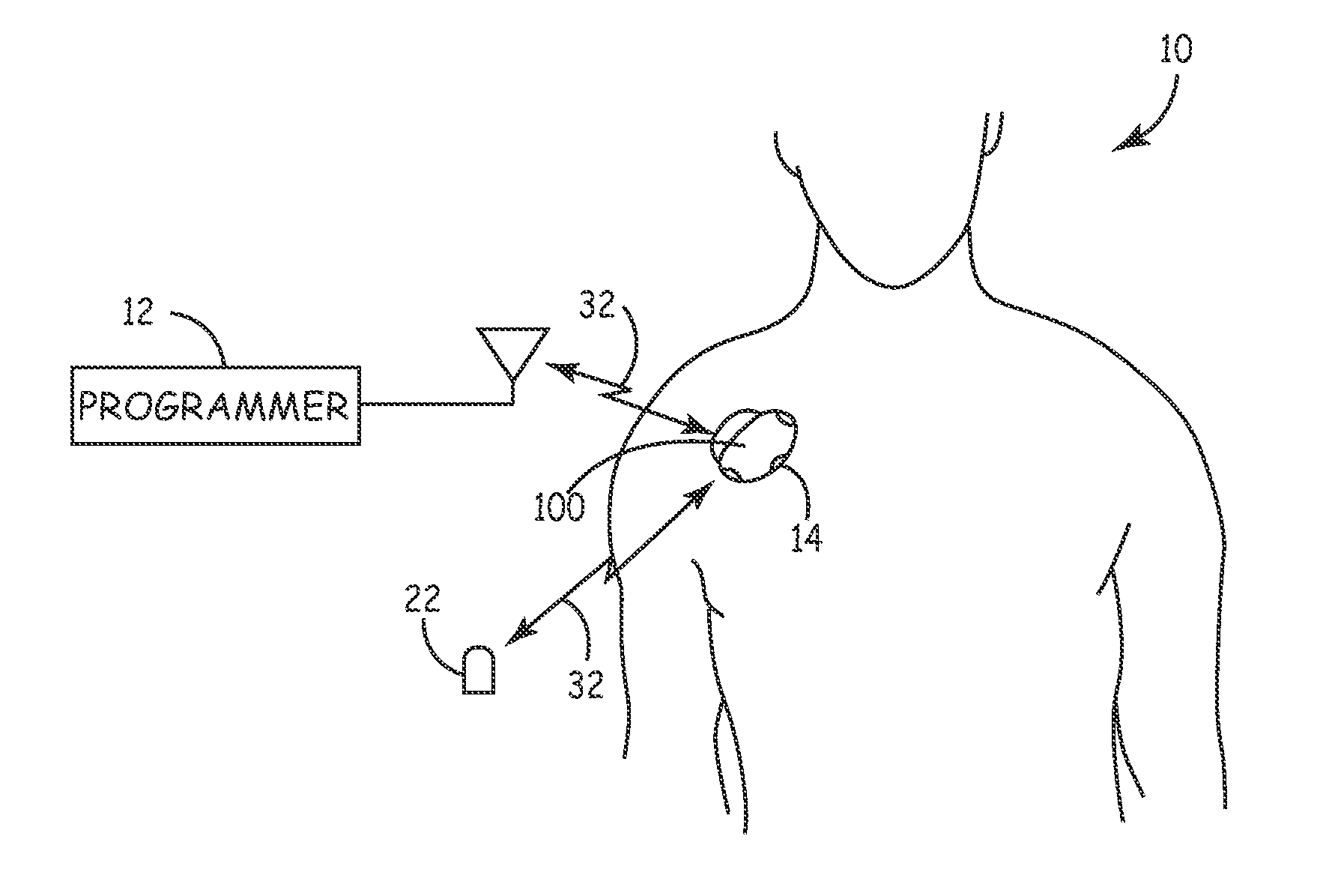 System and method for monitoring cardiac signal activity in patients with nervous system disorders