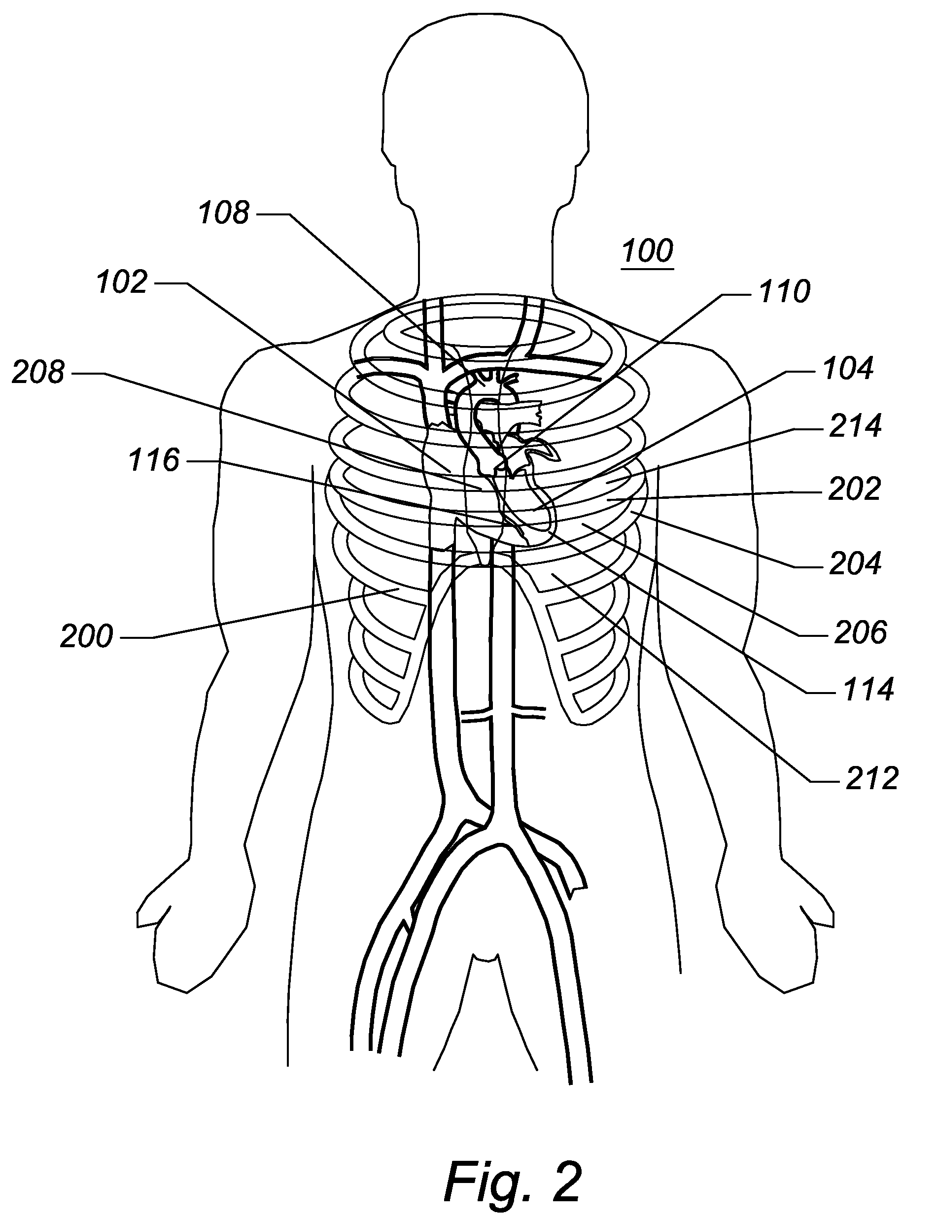 Expandable transapical sheath and method of use