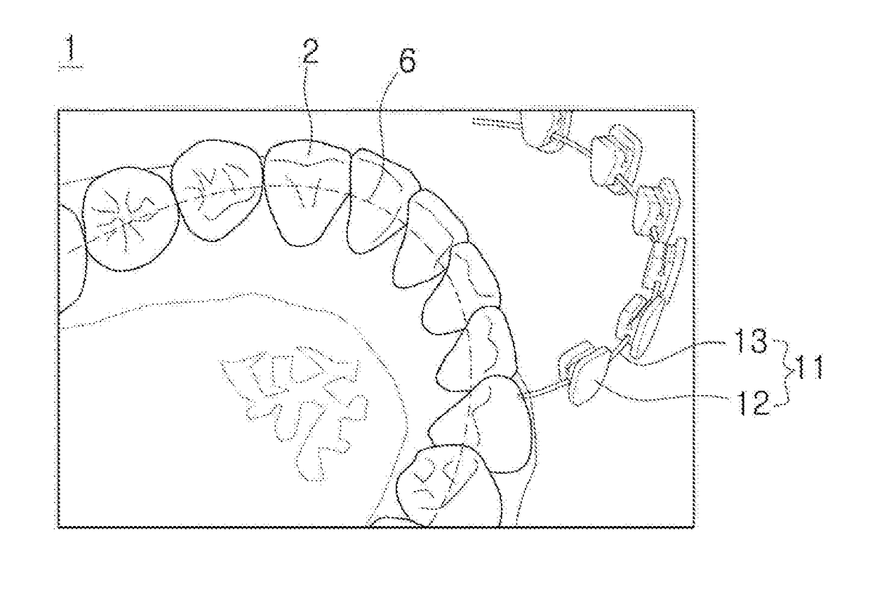 Orthodontic digital bracket for using digital library and method of manufacturing the same