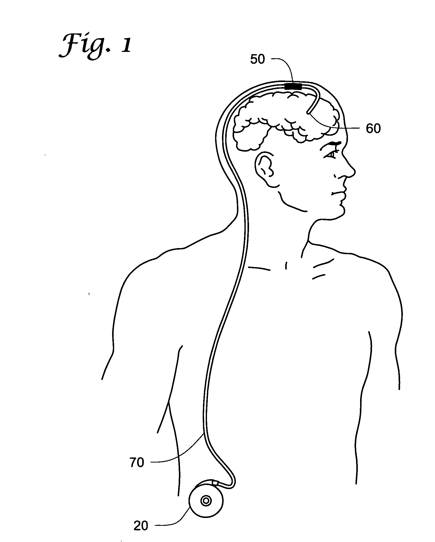 Strain relief device and connector assemblies incorporating same