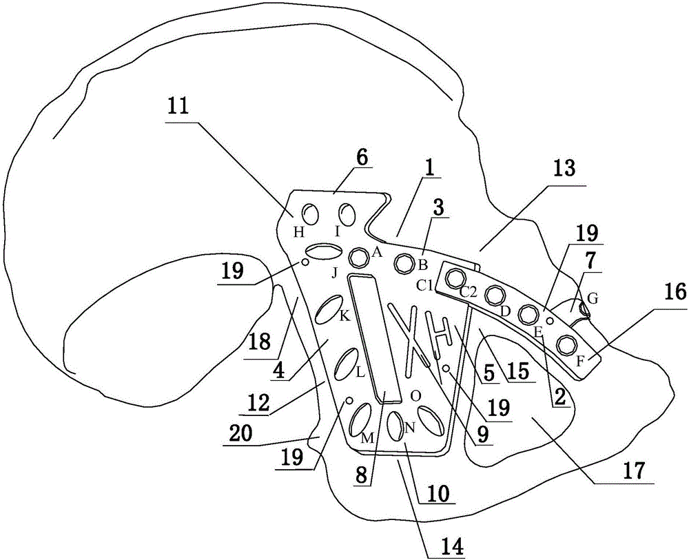 Fixation device and method for acetabular anterior and posterior columns and quadrangular fractures