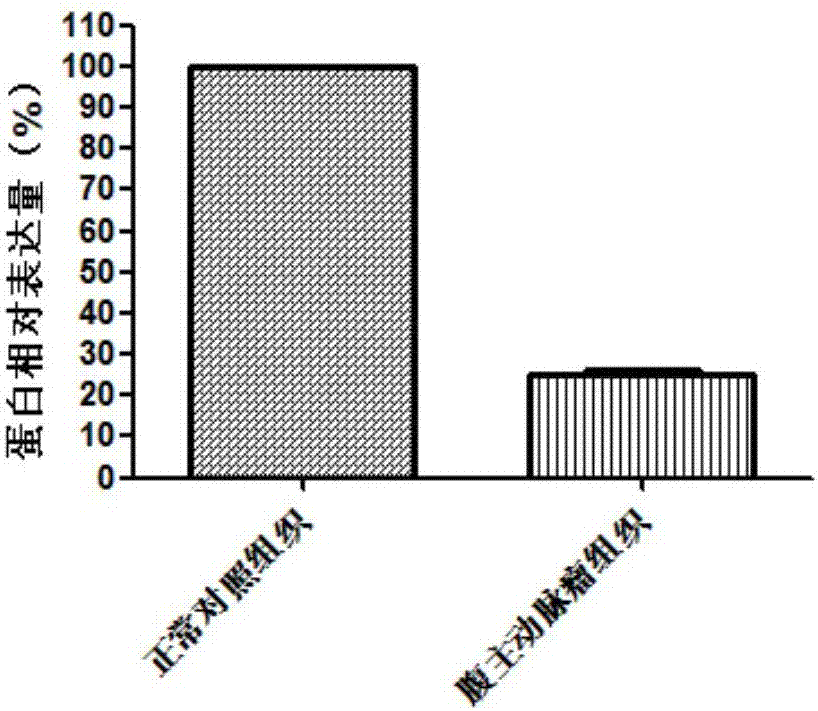 ACADL gene and application of expression product of ACADL gene to preparation of abdominal aortic aneurysm diagnosis and treatment product