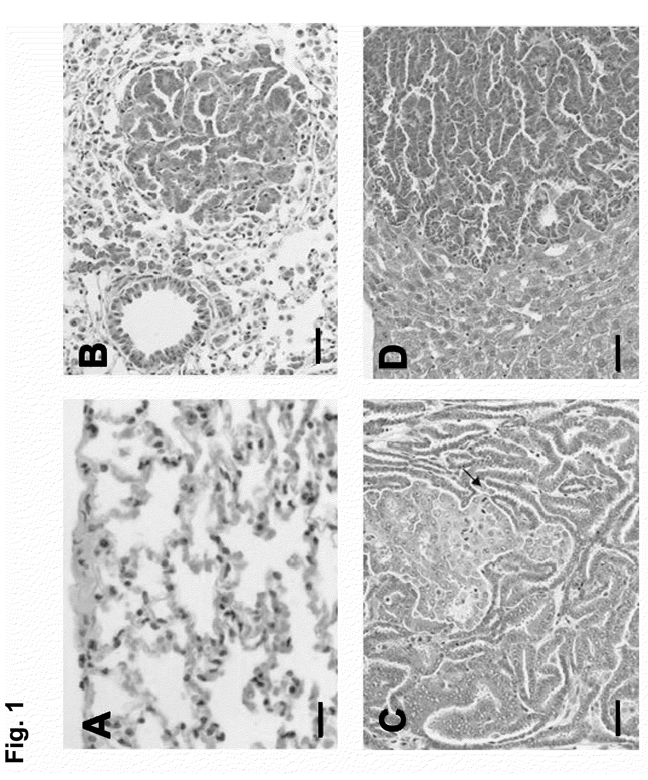 Medicament, compositions, and substances for treating and identifying adenocarcinoma of the lung