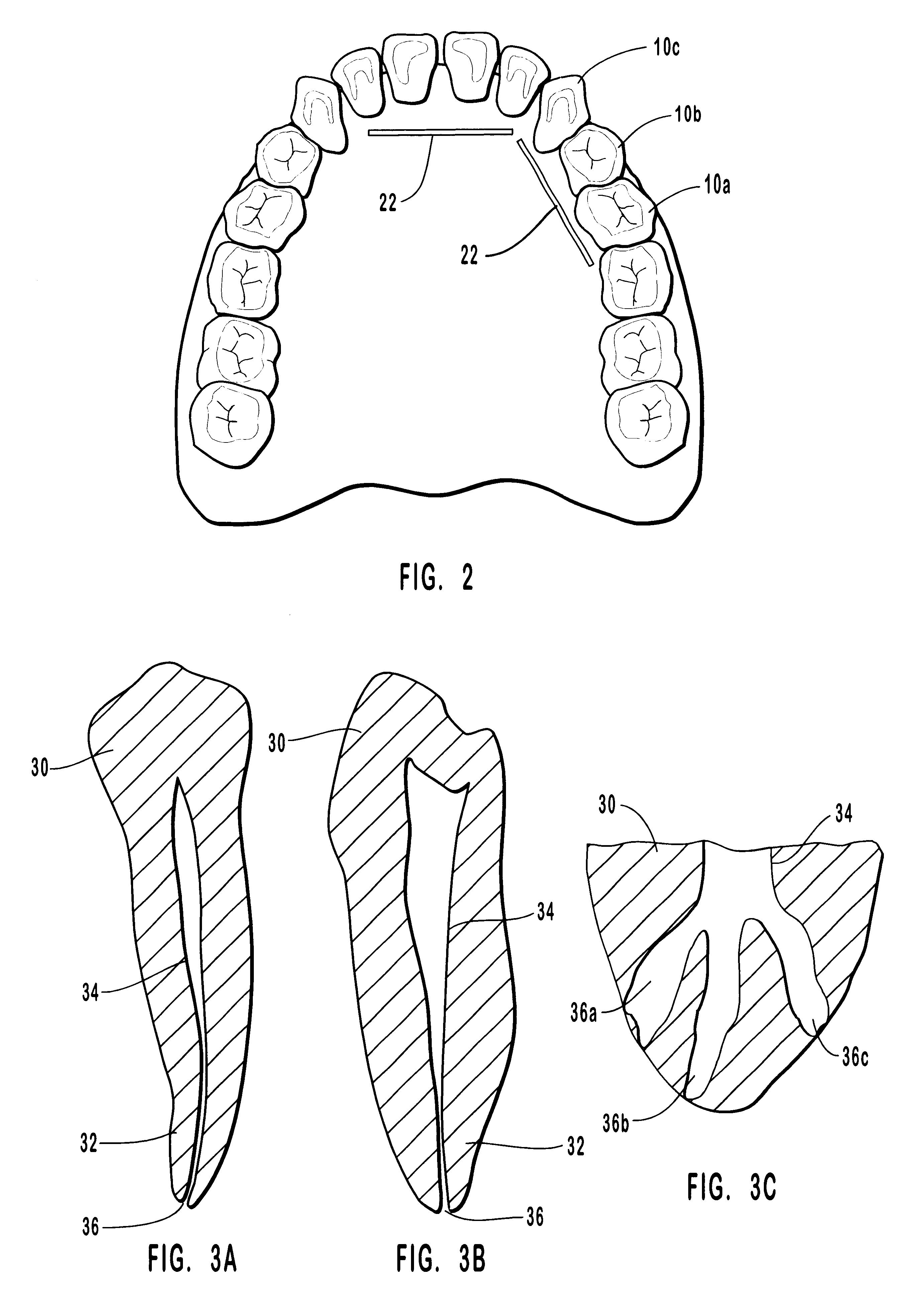 Endodontic systems and methods for the anatomicall, sectional and progressive corono-apical preparation of root canals with minimal apical intrusion