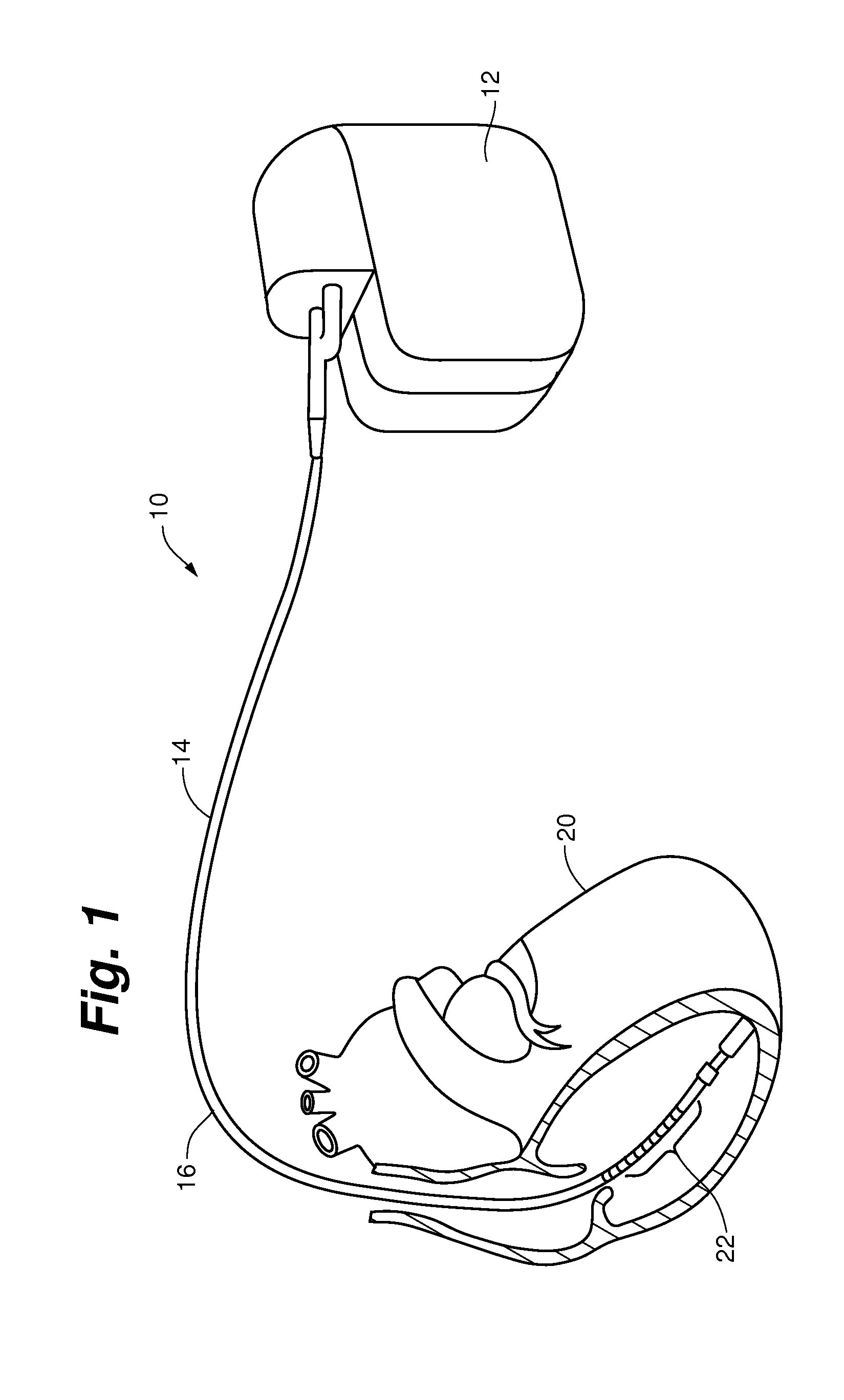 Method and apparatus for implantable cardiac lead integrity analysis