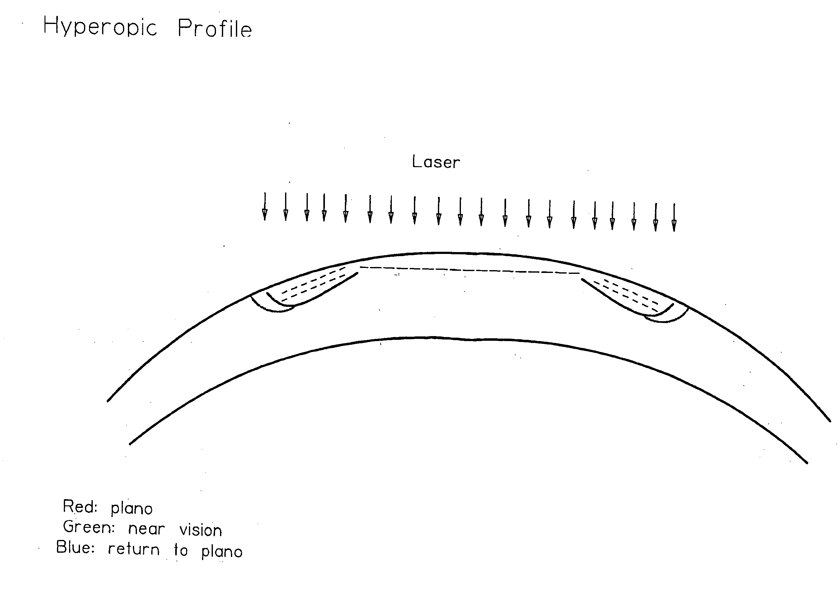 Apparatus for correcting presbyopia