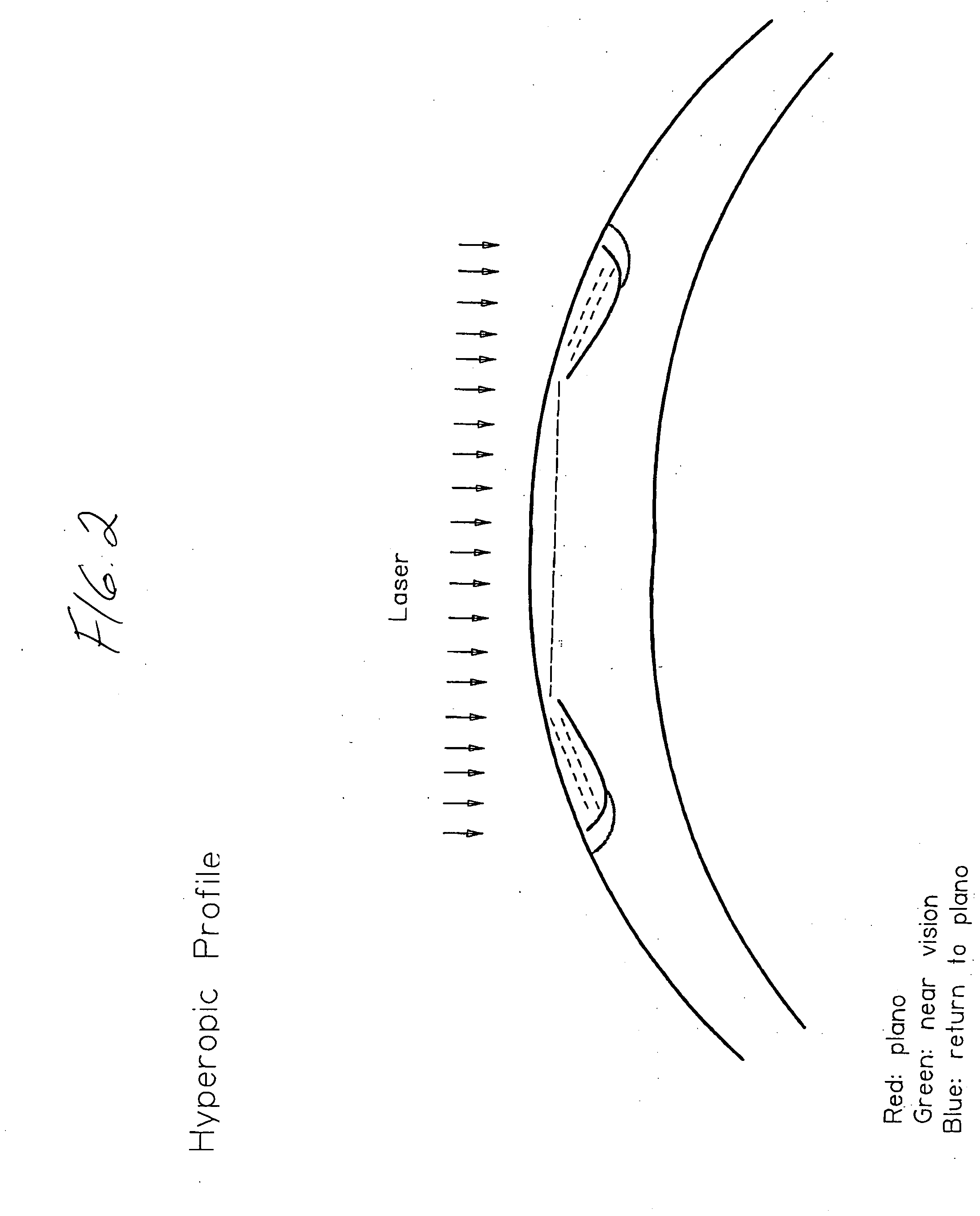 Apparatus for correcting presbyopia