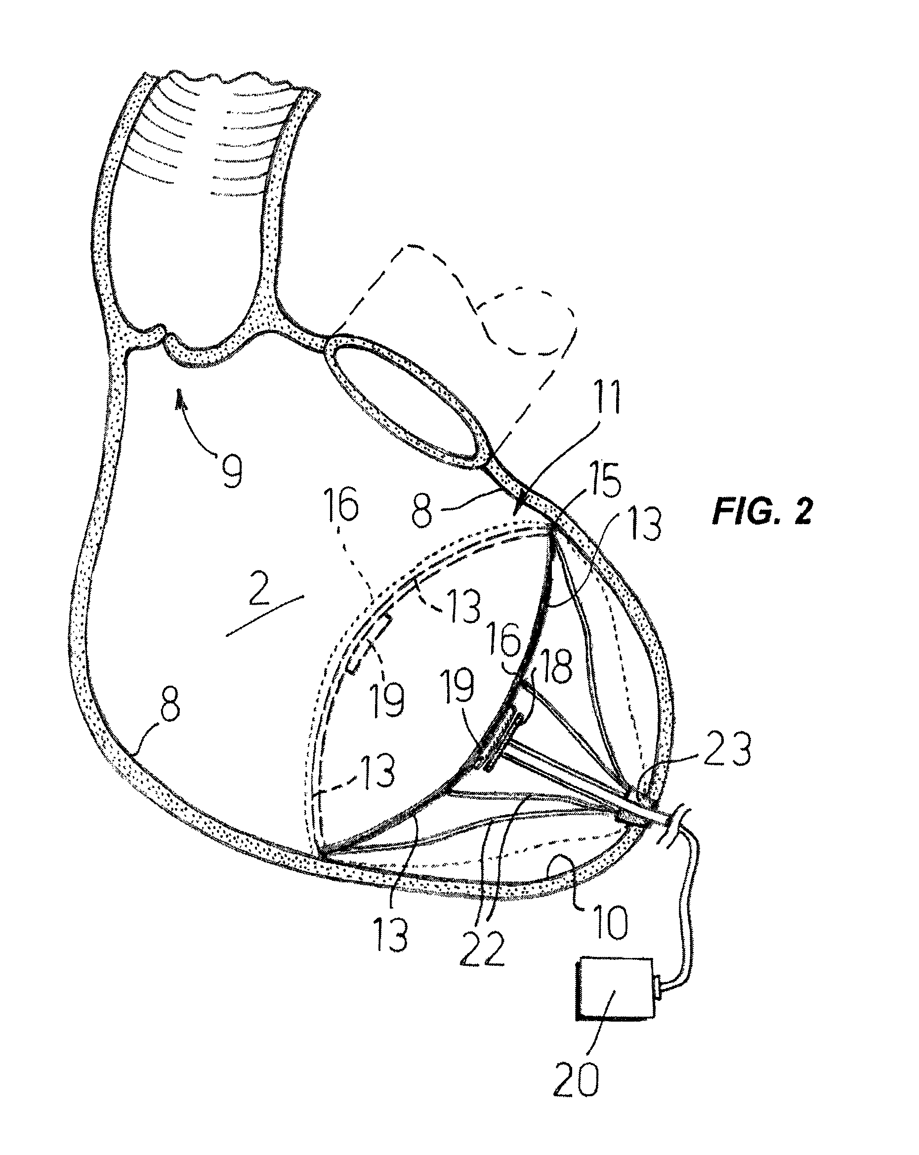 Cardiovascular device