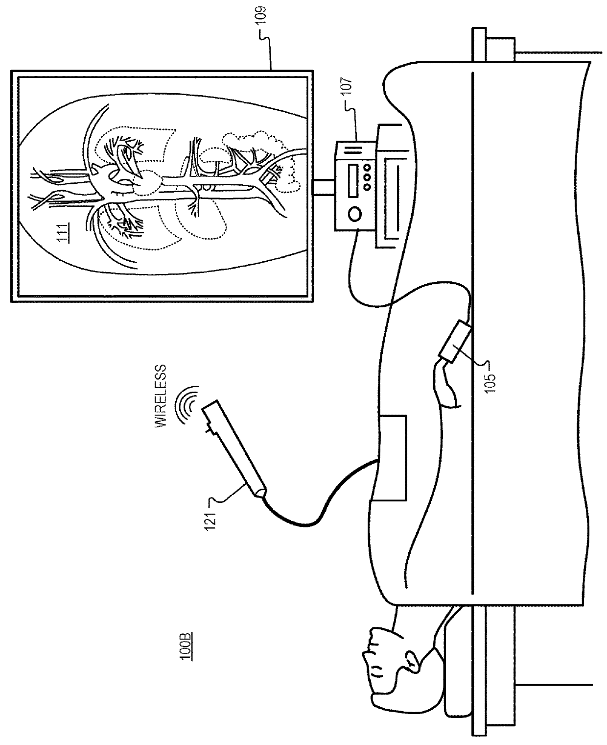 Detection of Blood Vessels