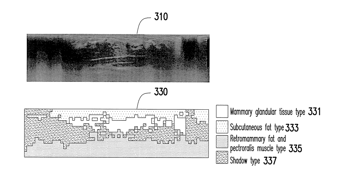 Medical image processing apparatus and breast image processing method thereof