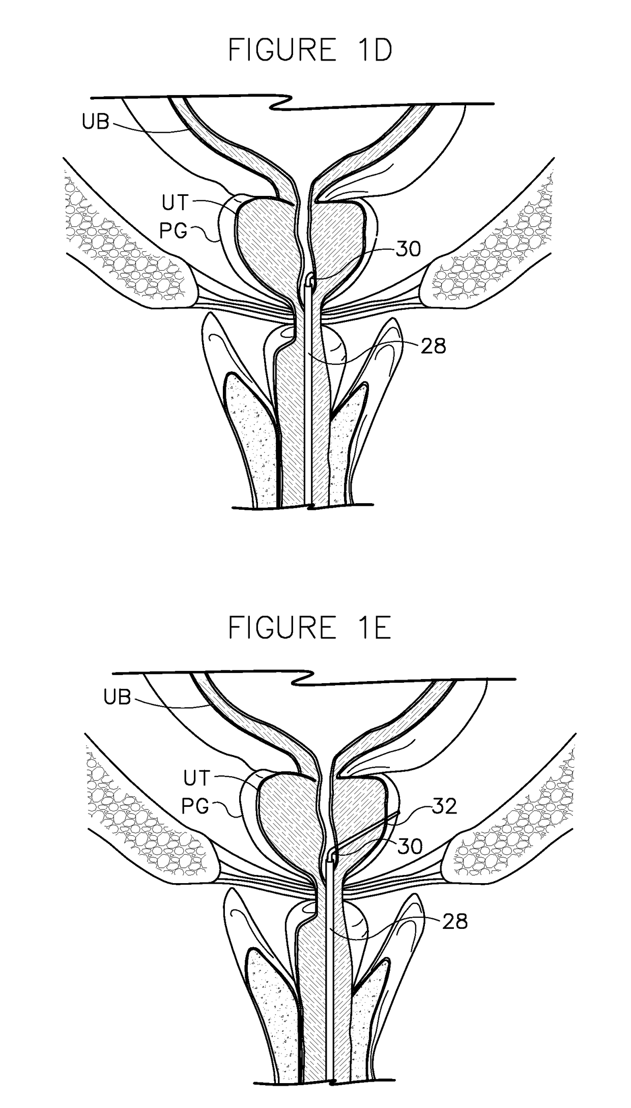 System with reloadable handle for delivering an anchor