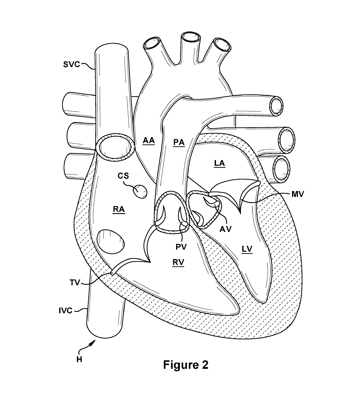 Native valve repair devices and procedures