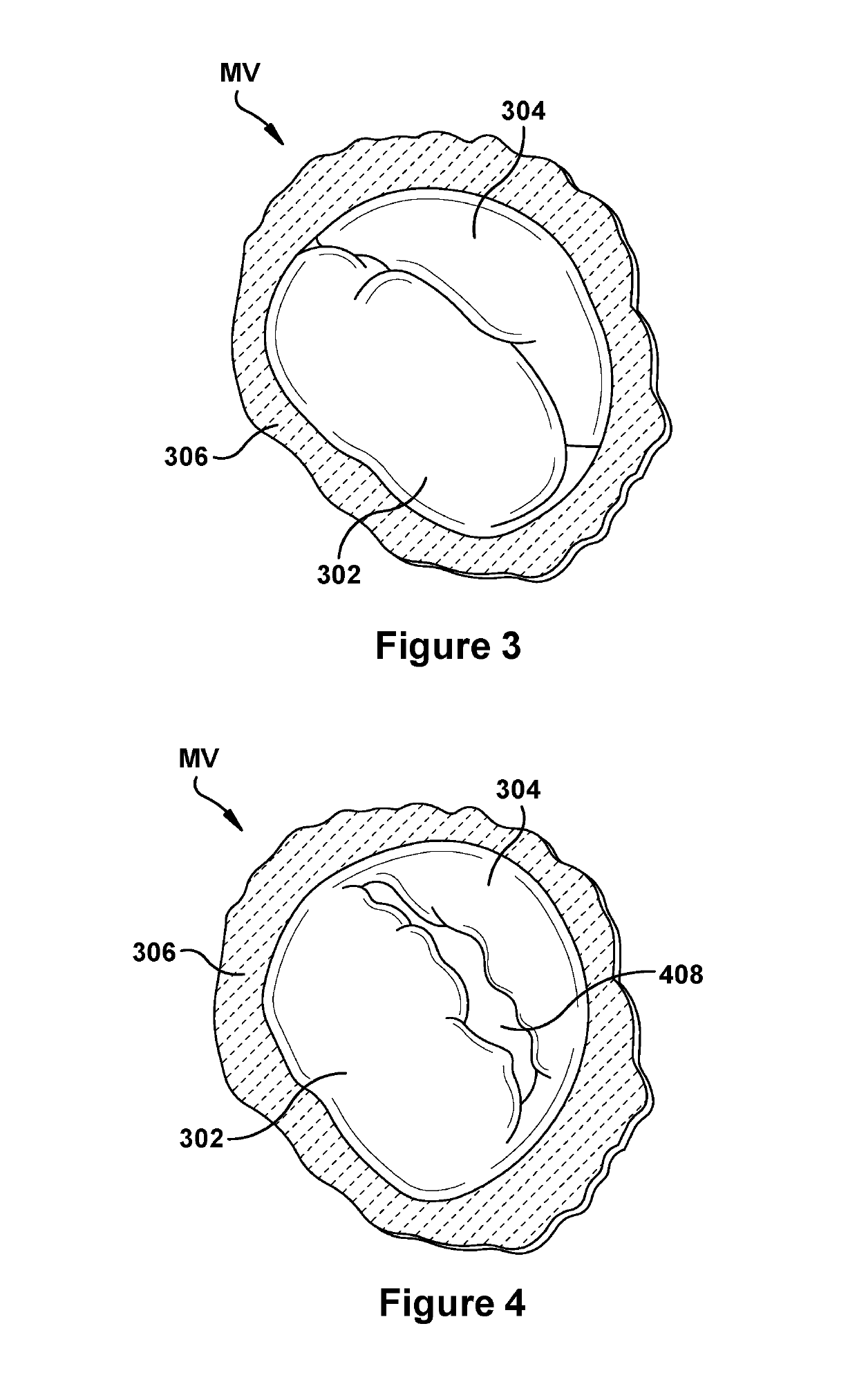 Native valve repair devices and procedures