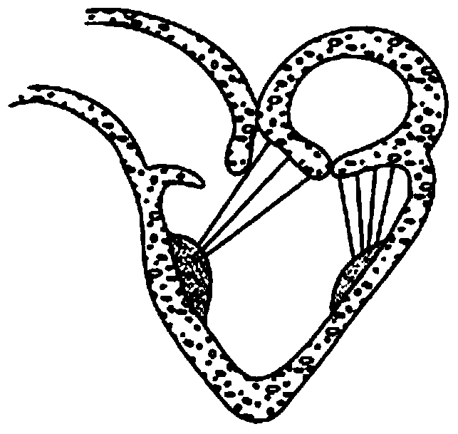 Artificial chordae tendineae device and threading element and suite