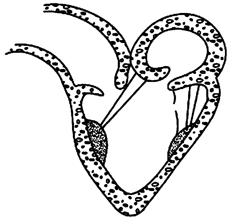 Artificial chordae tendineae device and threading element and suite