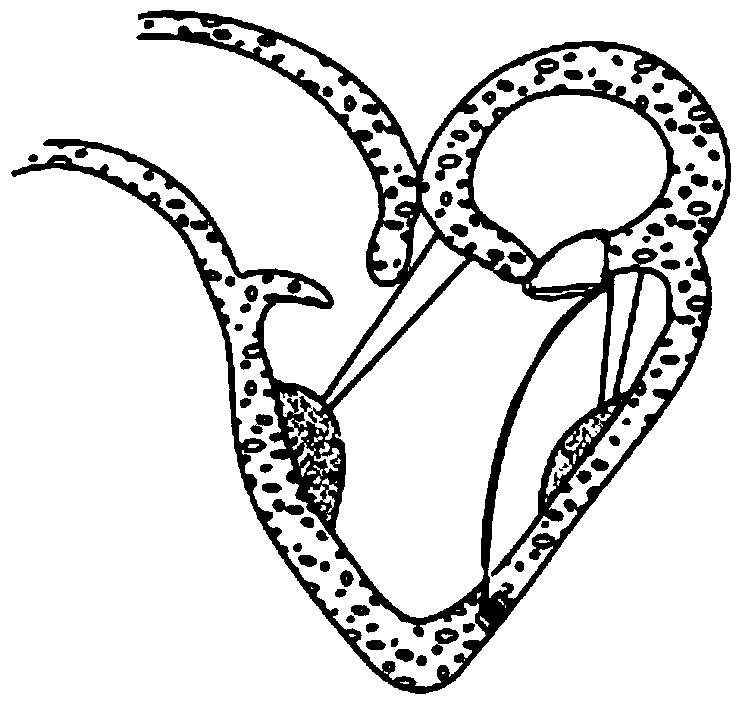 Artificial chordae tendineae device and threading element and suite