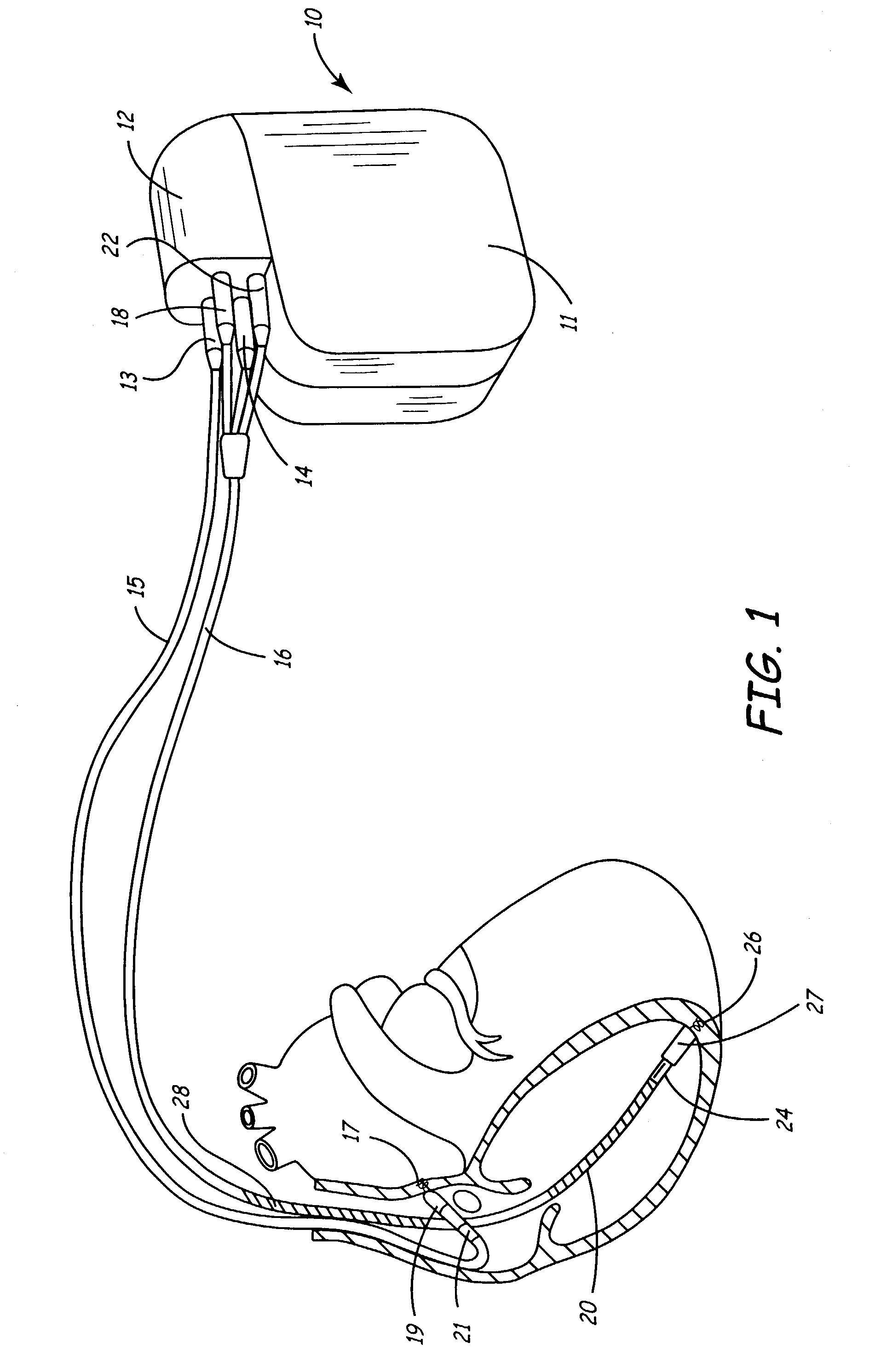 Apparatus and method using ATP return cycle length for arrhythmia discrimination