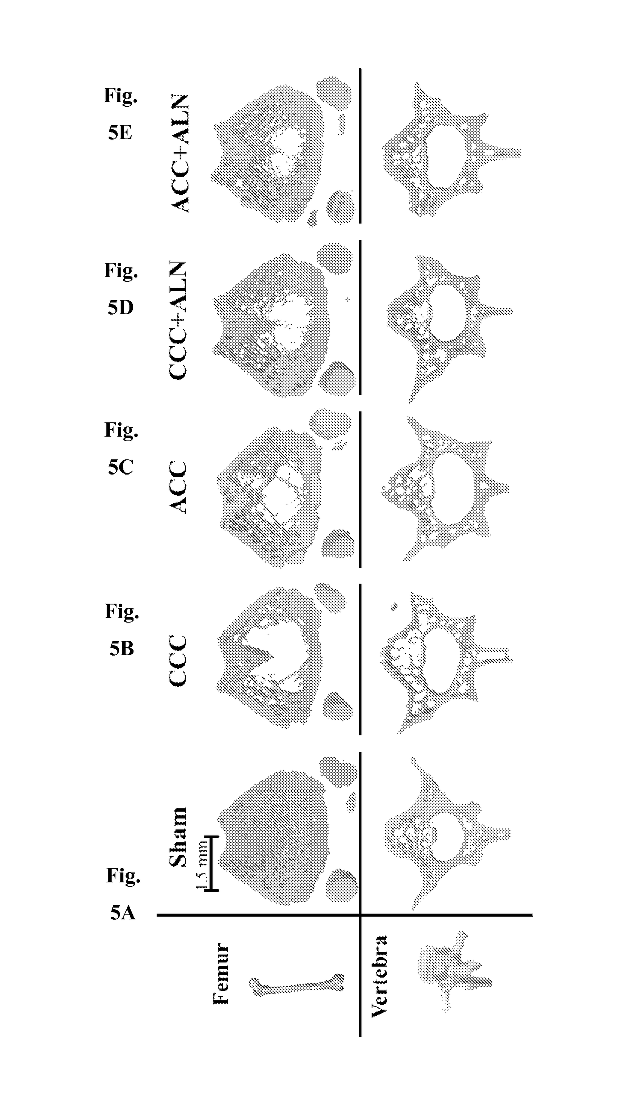 Amorphous calcium carbonate for the treatment of calcium malabsorption and metabolic bone disorders