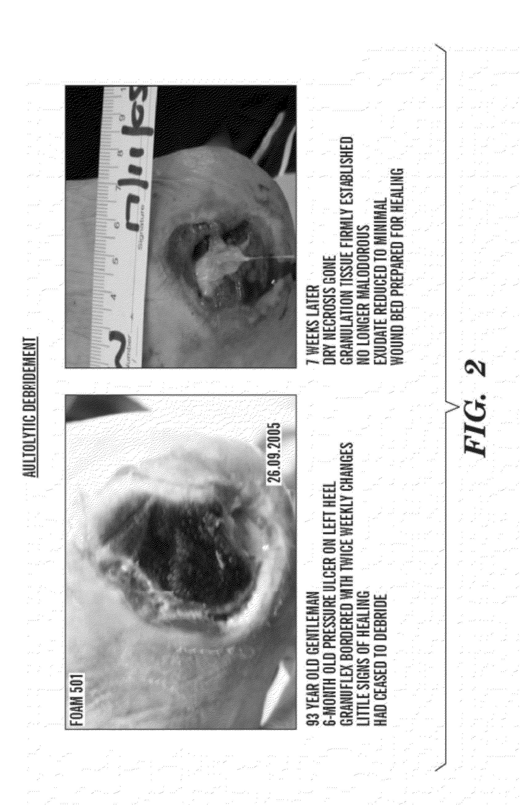 Treatment of chronic ulcerous skin lesions