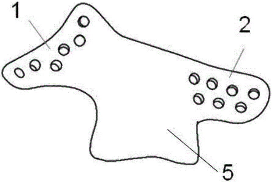 Zygomatic arch temporal-mandibular joint glenoid fossa combined remediation prosthesis