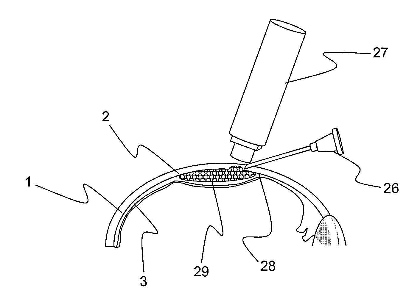 Apparatus and formulations for suprachoridal drug delivery