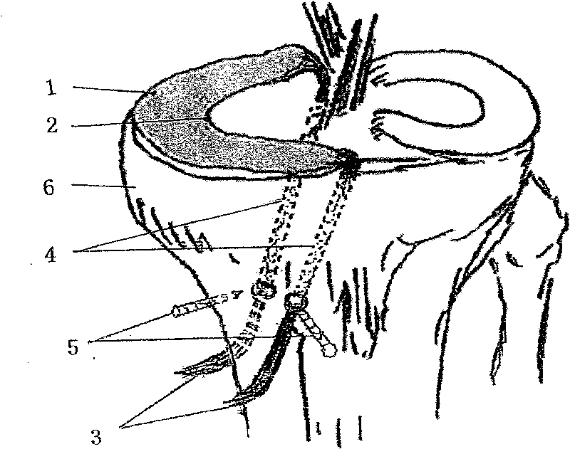 Method for preparing medical knee joint semilunar cartilage