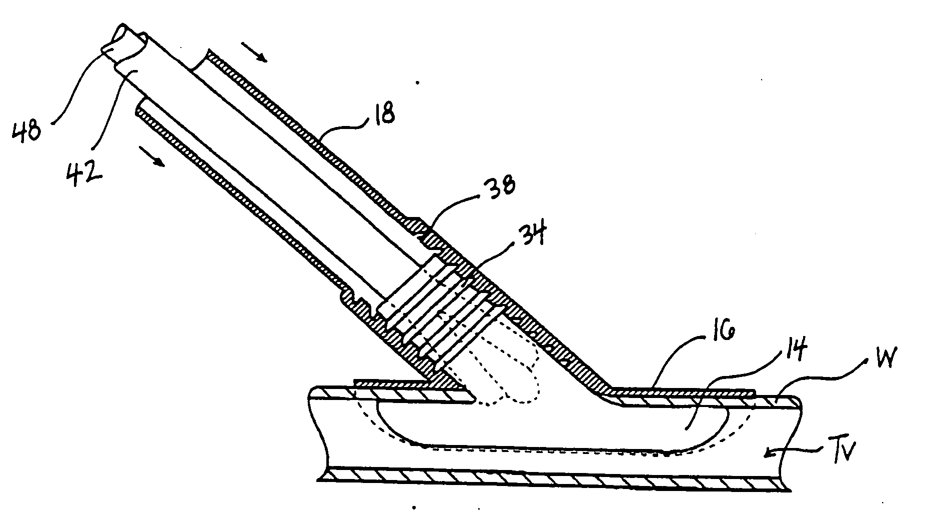 Methods and devices for placing a conduit in fluid communication with a target vessel and a source of blood