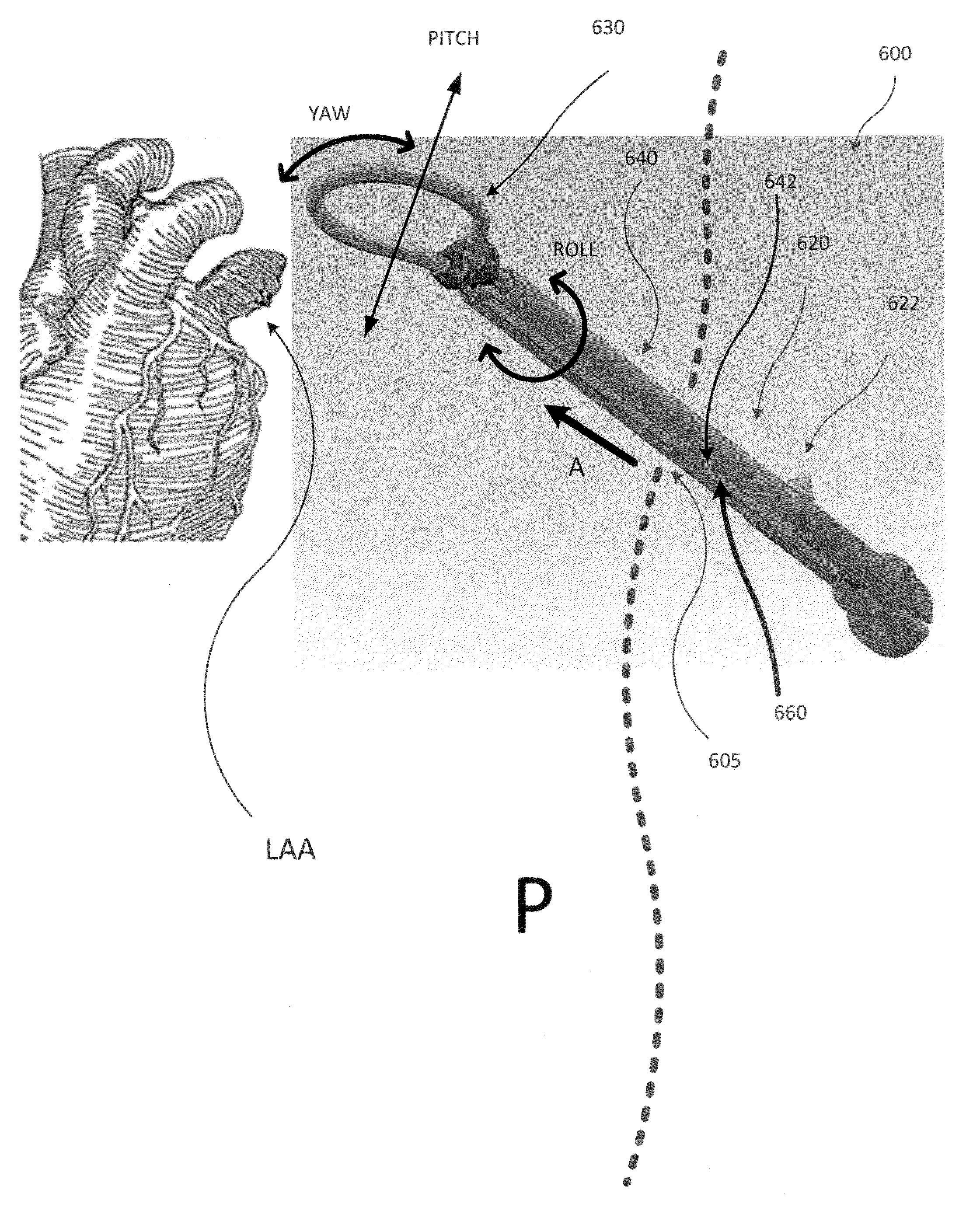 Left atrial appendage treatment systems and methods