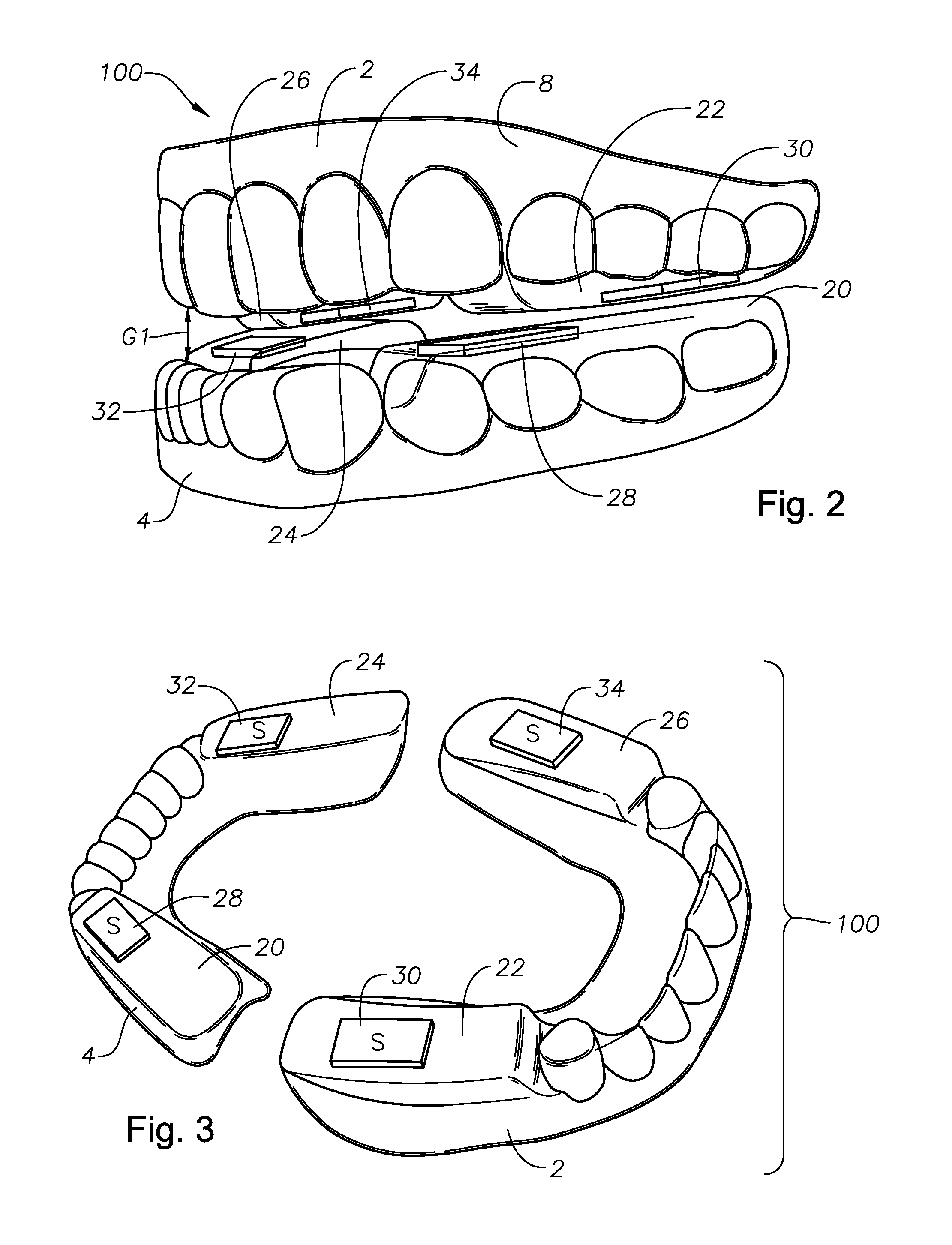 Oral devices, kits, and methods for reducing sleep apnea, snoring, and/or nasal drainage