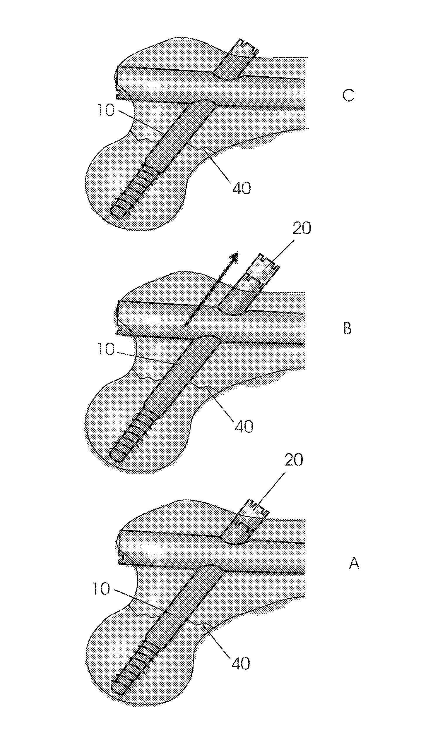 Modular lag screw