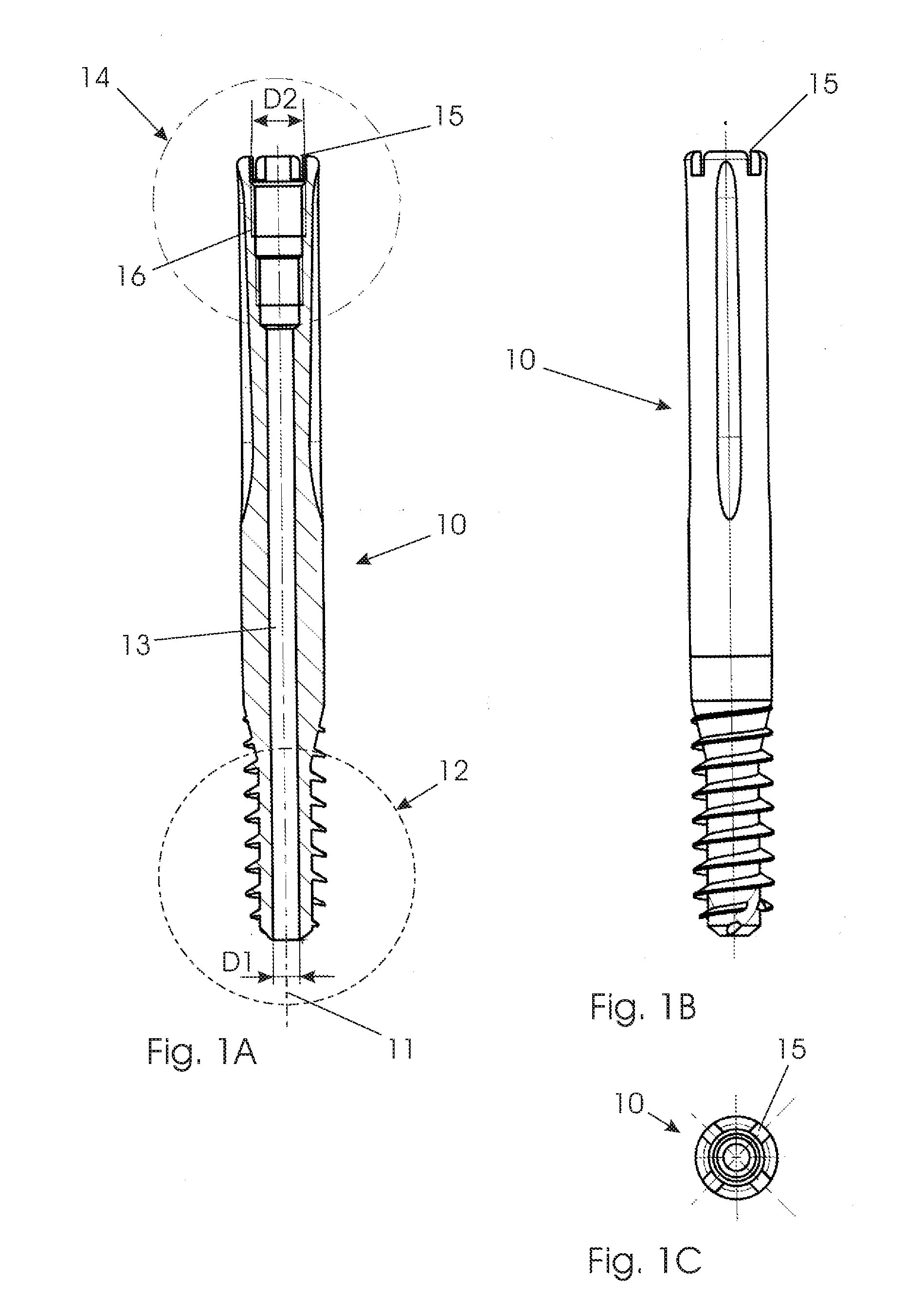 Modular lag screw