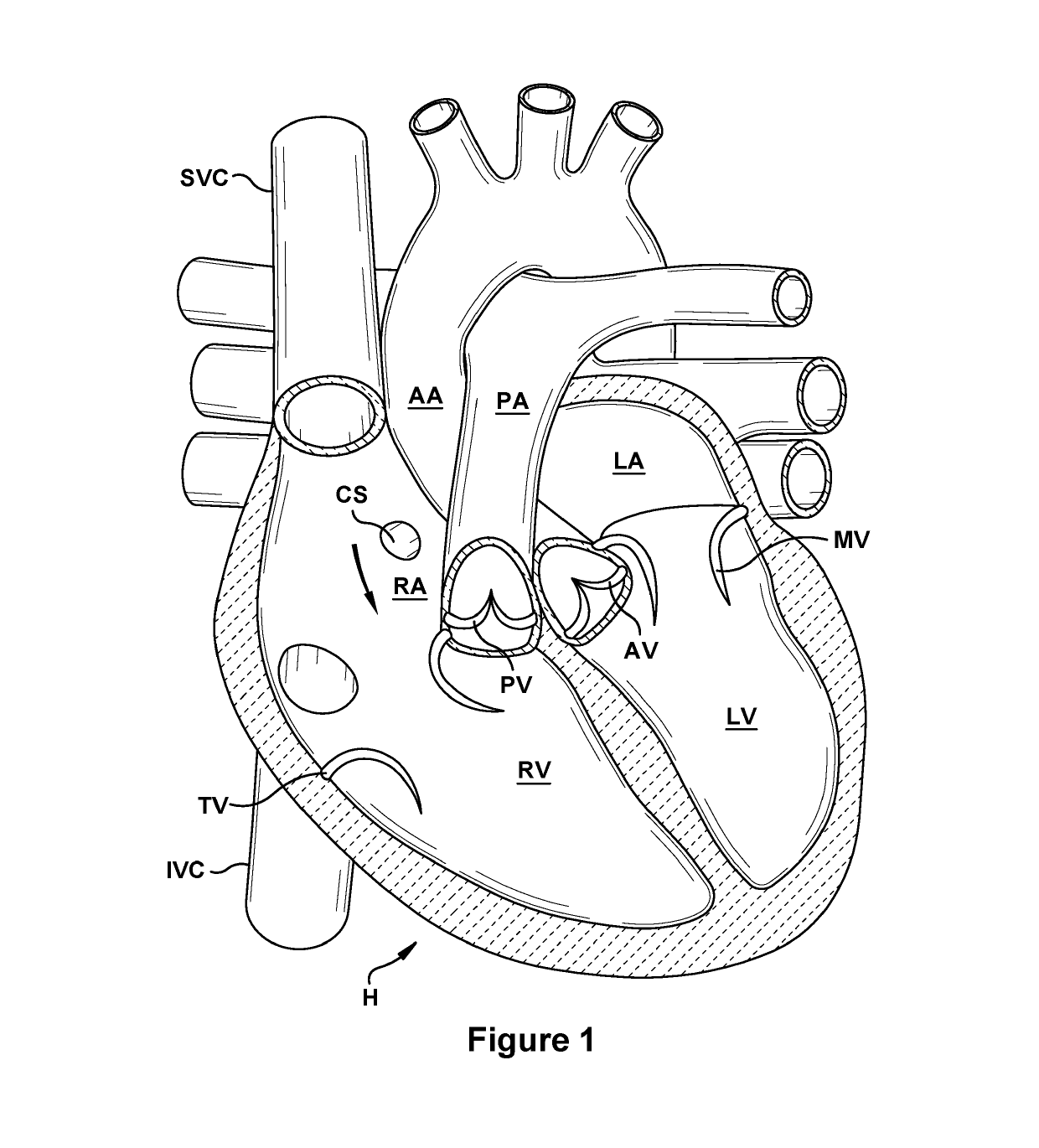 Native valve repair devices and procedures