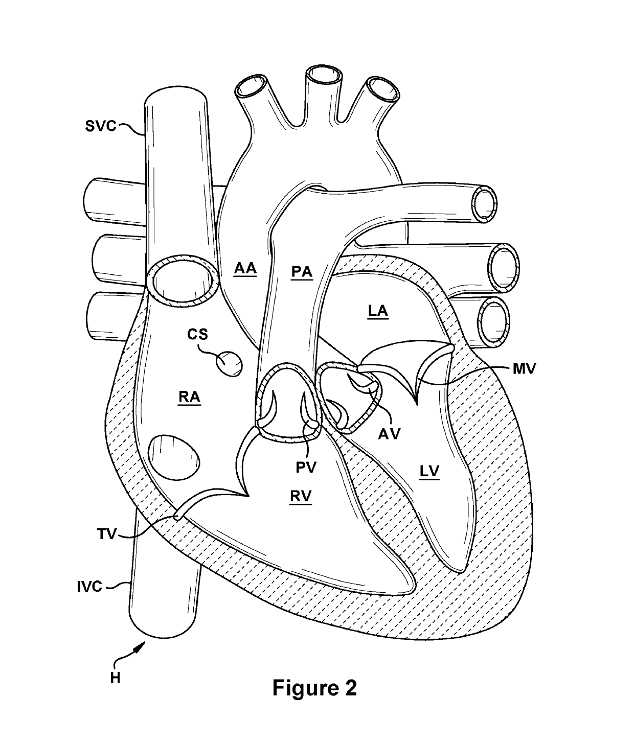 Native valve repair devices and procedures