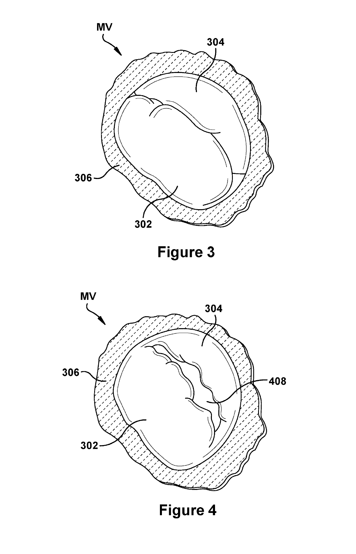 Native valve repair devices and procedures