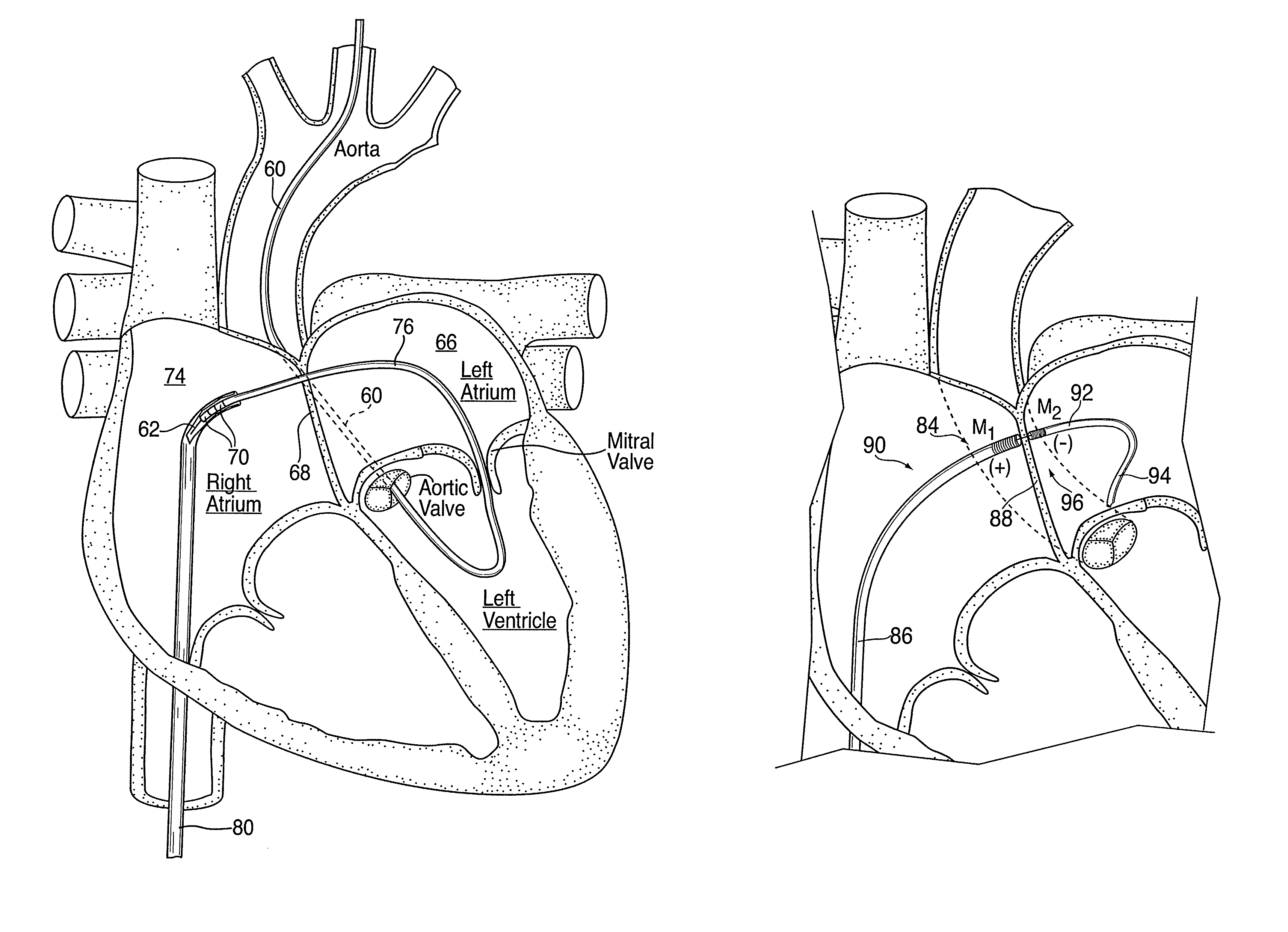 Apparatus for safe performance of transseptal technique and placement and positioning of an ablation catheter