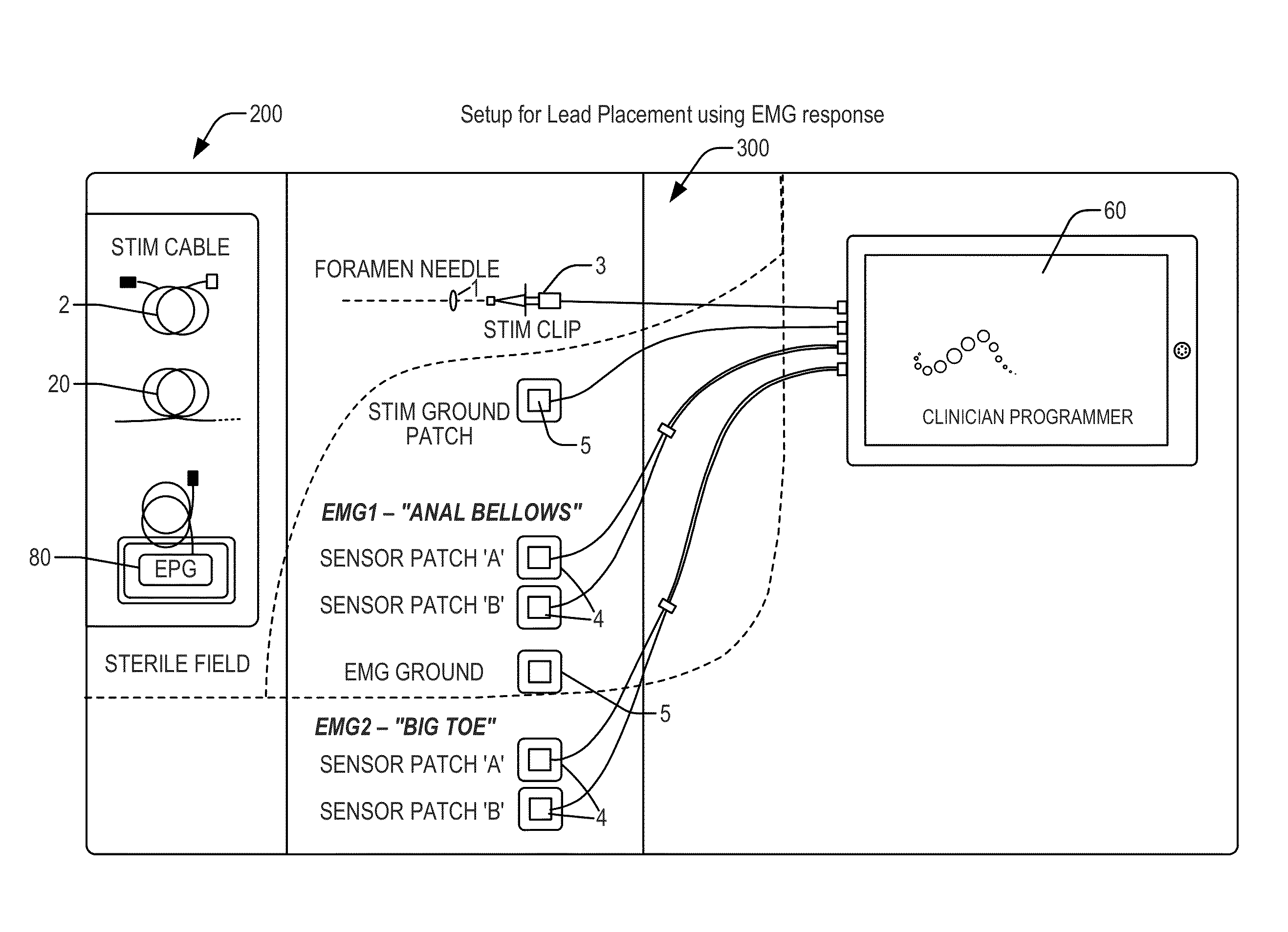 Electromyographic Lead Positioning and Stimulation Titration in a Nerve Stimulation System for Treatment of Overactive Bladder