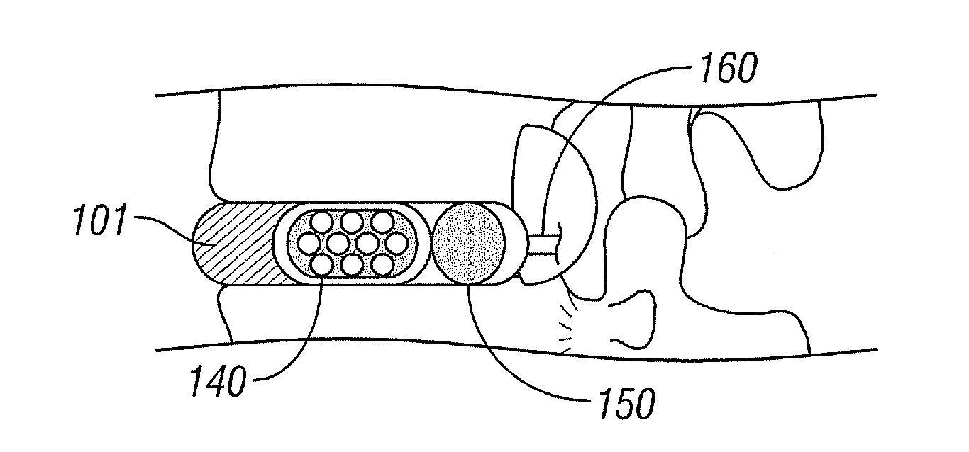 Intervertebral Nucleus and Annulus Implants and Method of Use Thereof