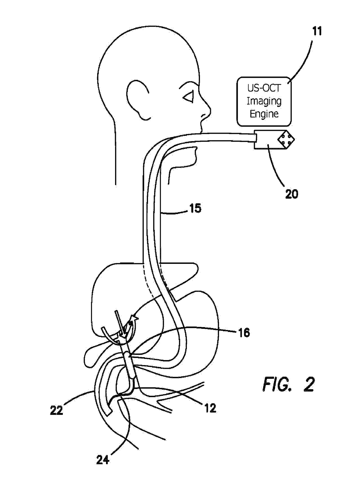 Integrated ultrasound, OCT, PA and/or florescence imaging endoscope for diagnosing cancers in gastrointestinal, respiratory, and urogenital tracts