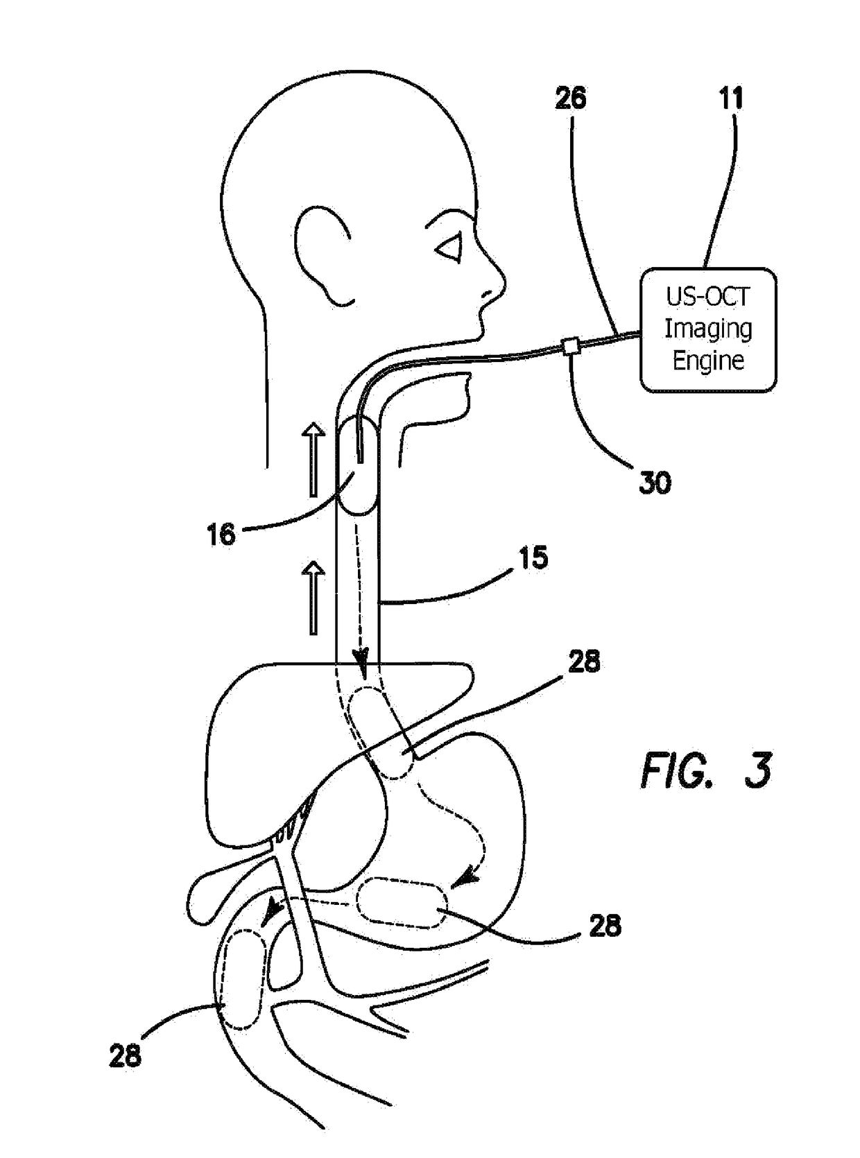 Integrated ultrasound, OCT, PA and/or florescence imaging endoscope for diagnosing cancers in gastrointestinal, respiratory, and urogenital tracts