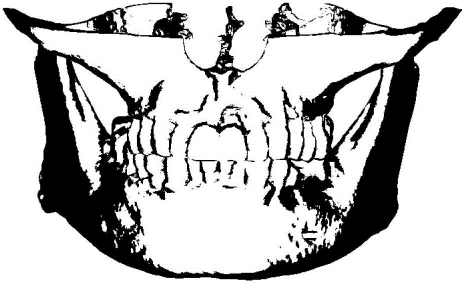 Individuation orthodontic method based on shape memory polymer arch wire