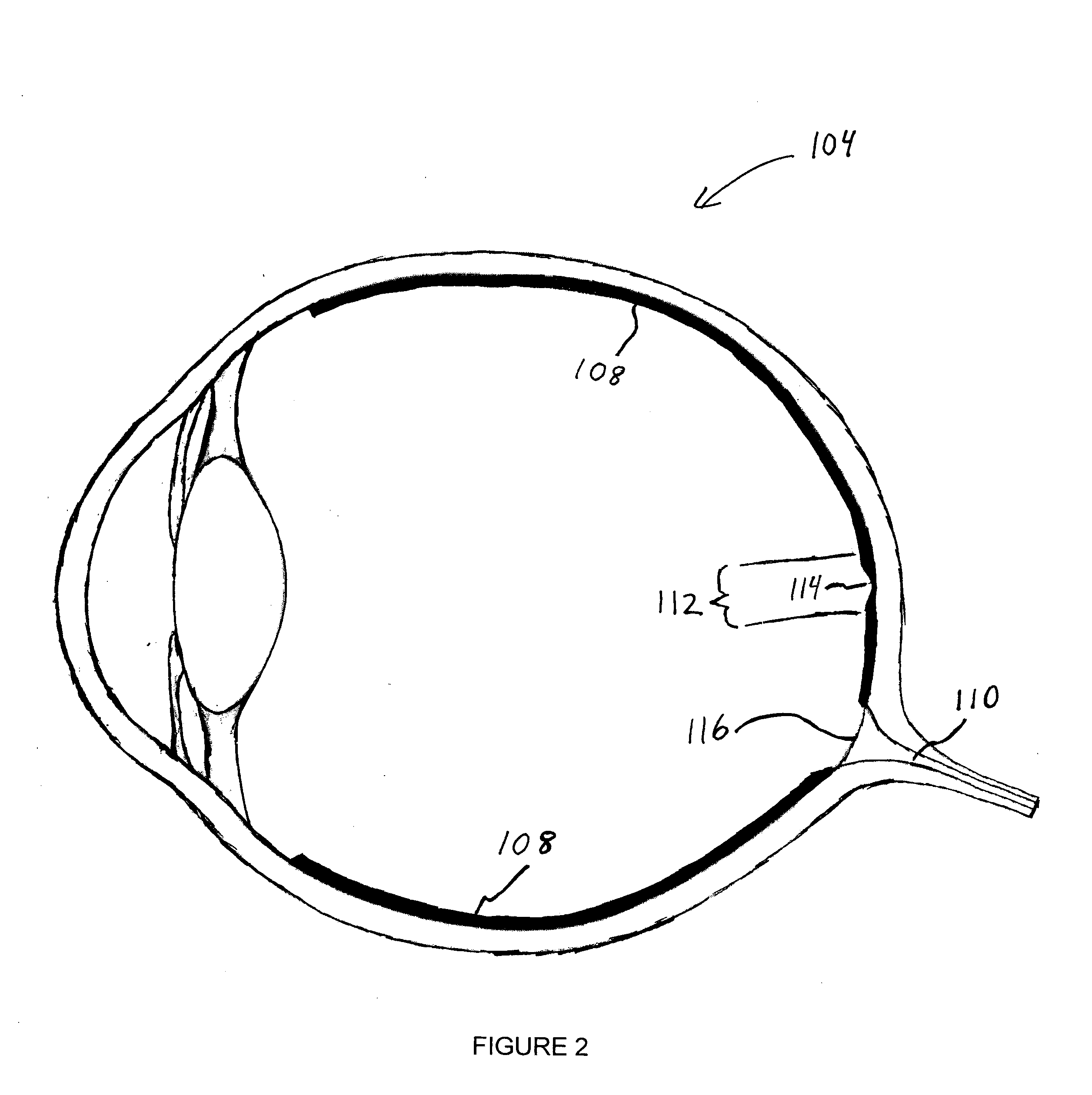 Method and system for treating binocular anomalies